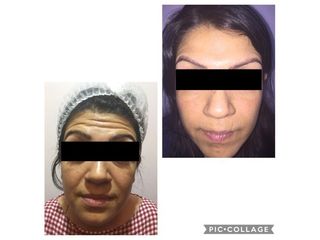 Antes y después de Aplicación de toxina botulínica  