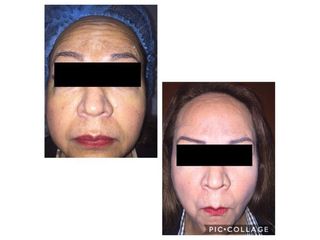Antes y después de Aplicación de toxina botulínica  