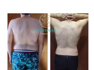 Antes y después de Radiofrecuencia 