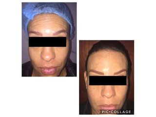 Antes y después de Aplicación de toxina botulínica 