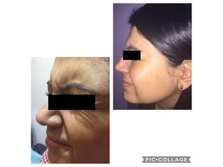 Antes y después de Aplicación de toxina botulínica 