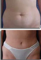 Abdominoplastia - Dr. Miguel Angel Alarcón Alarcón