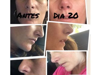 Rinoplastia antes y después - 552306