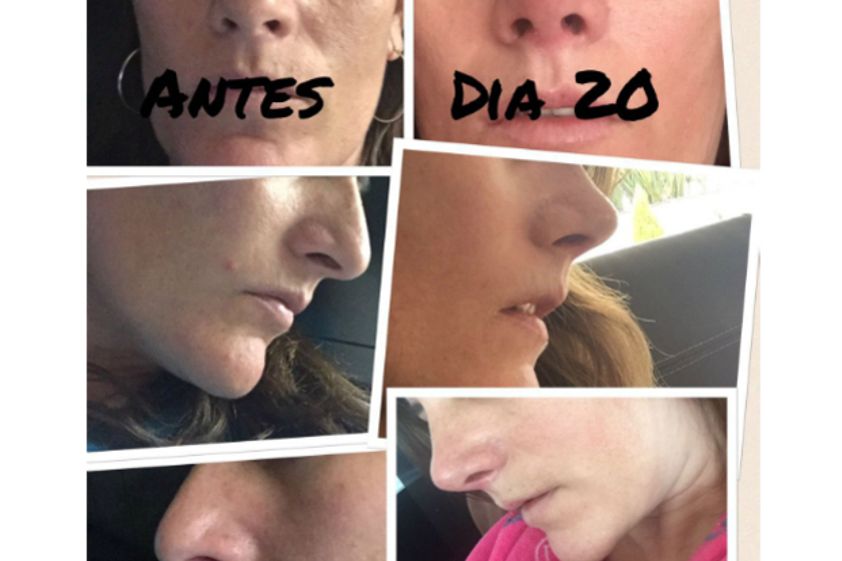 Rinoplastia antes y después - 552306