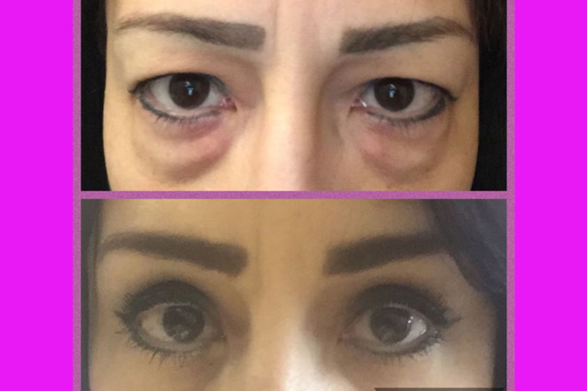 Blefaroplastia antes y después - 634524