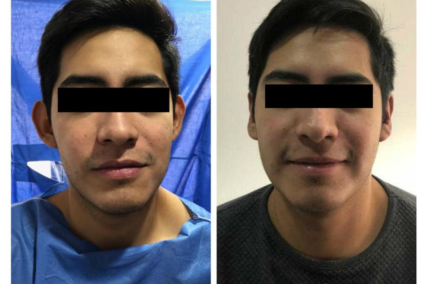 Otoplastia antes y después - 634527