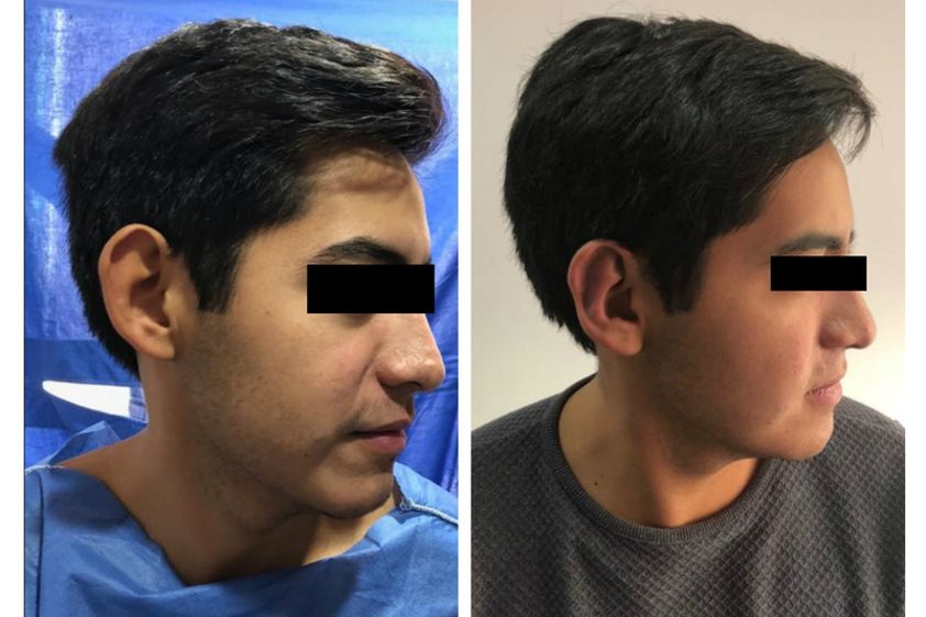 Otoplastia antes y después - 634528