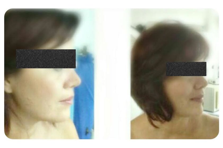 Rejuvenecimiento facial antes y después - 634531