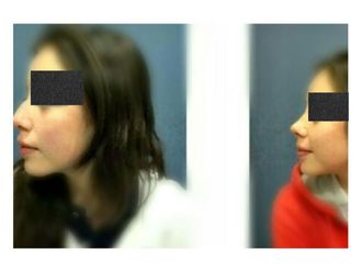 Rinoplastia antes y después - 634533