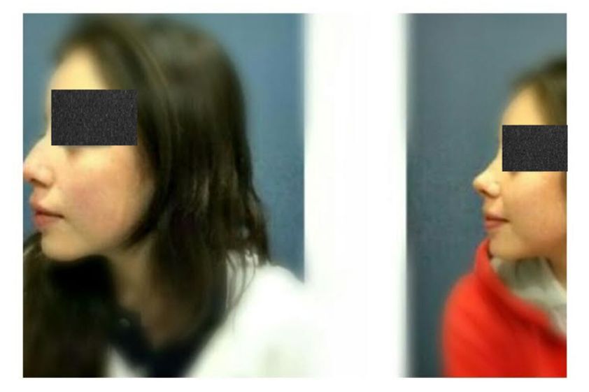 Rinoplastia antes y después - 634533
