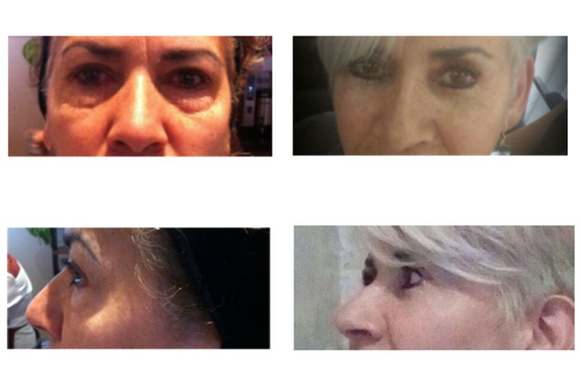 Blefaroplastia antes y después - 634534
