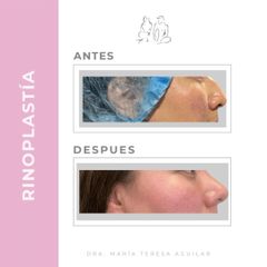 Rinoplastia  - Dra. María Teresa Aguilar Ibarra