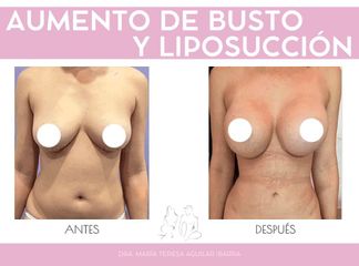 Aumento de Busto + Liposucción - Dra. María Teresa Aguilar Ibarra