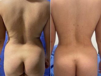 Abdominoplastia antes y después - 879230