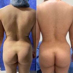 Abdominoplastia