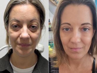Rejuvenecimiento facial antes y después - 879231