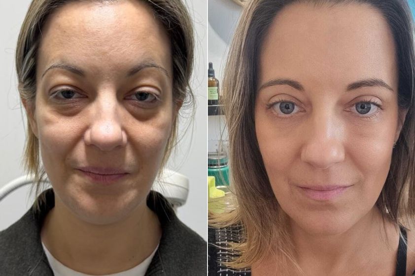 Rejuvenecimiento facial antes y después - 879231