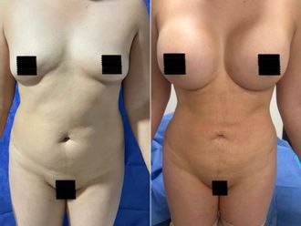 Abdominoplastia antes y después - 879232