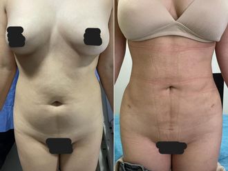 Abdominoplastia antes y después - 879233