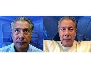 Antes y después de una Blefaroplastía