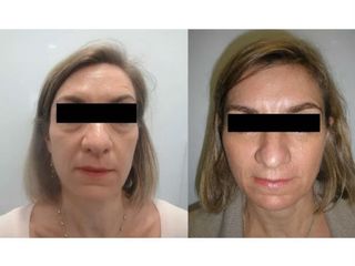 Antes y después de una Blefaroplastía