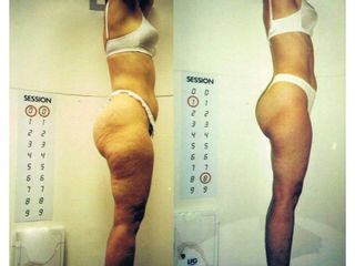 Antes y después de tratamientos anticelulíticos.  Endermología