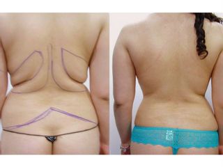 Antes y después de una liposucción