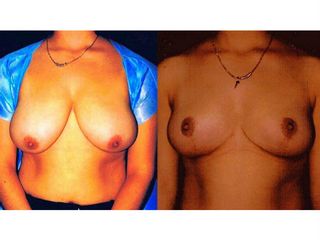 Antes y después de unaMamoplastía de reducción
