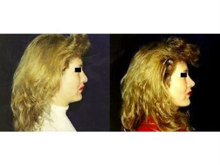 Antes y después de una Rinoplastía más Mentoplastía