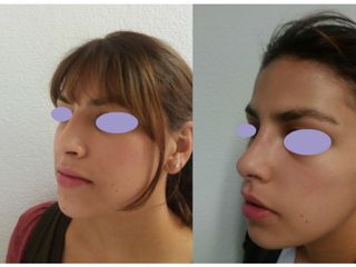 Antes y después de Rinoplastia 