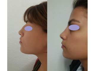 Antes y después de Rinoplastia 