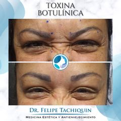 Toxina Botulínica  - Dr. Felipe Tachiquin