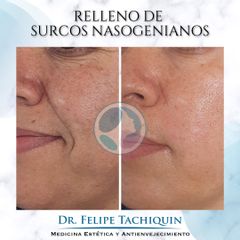 Relleno surcos nasogenianos - Dr. Felipe Tachiquin