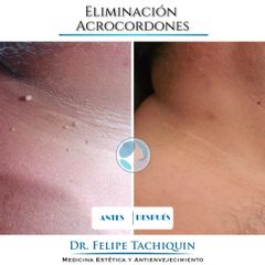 Acrocordones - Dr. Felipe Tachiquin