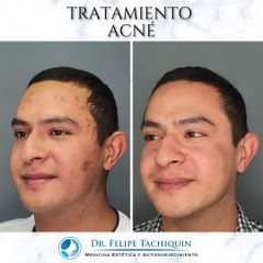 Tratamiento antiacné - Dr. Felipe Tachiquin