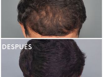 Alopecia antes y después - 861347