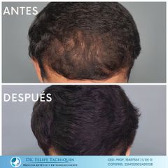 Alopecia - Dr. Felipe Tachiquin