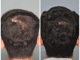 Alopecia antes y después - 861348