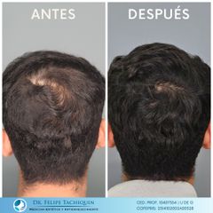 Alopecia - Dr. Felipe Tachiquin