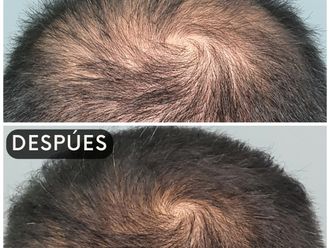 Alopecia antes y después - 861349