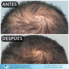 Alopecia - Dr. Felipe Tachiquin