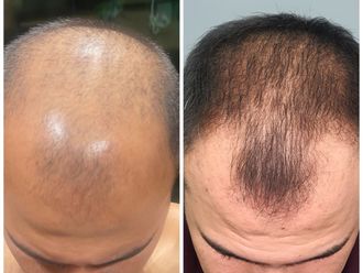 Alopecia antes y después - 861350