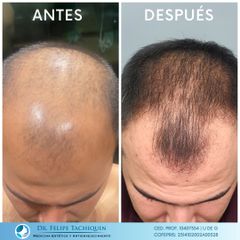 Alopecia - Dr. Felipe Tachiquin