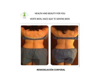 Antes y después de Remodelación Corporal