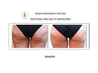 Antes y después de tratamientos para celulitis