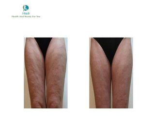 Antes y después de Flacidez en piernas 