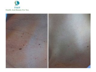 Antes y después de Fibromas 