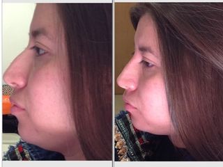 Antes y después de Corrección de nariz sin cirugia