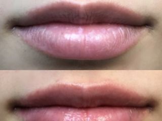 Antes y después de Volumen de labios