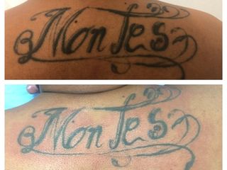 Antes y después de Retiro de Tatuaje 